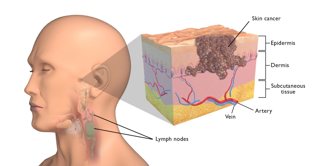 Skin Cancer (Face, Nose and Lip)